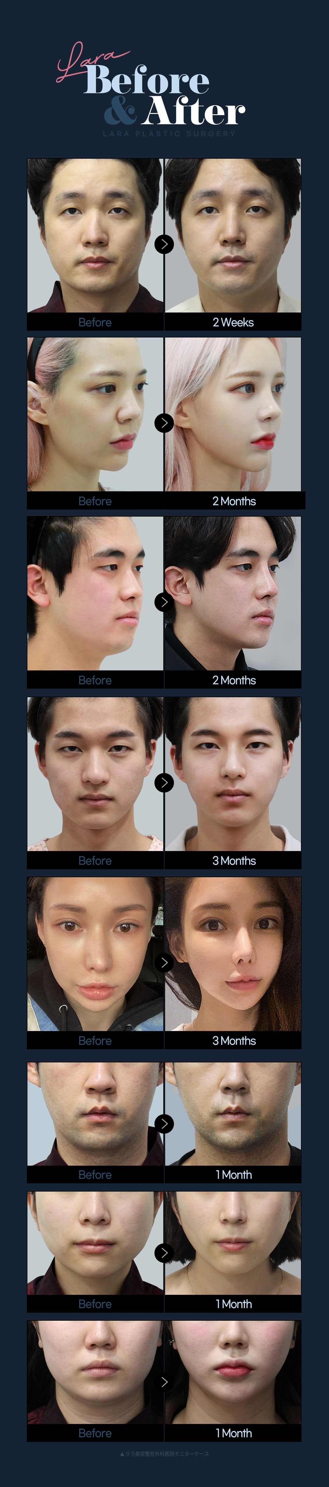 Hút mỡ mặt tạo V-line tự nhiên｜Thủ thuật tinh tế bằng phương pháp hút thủ công｜Lala Plastic Surgery ga Gangnam