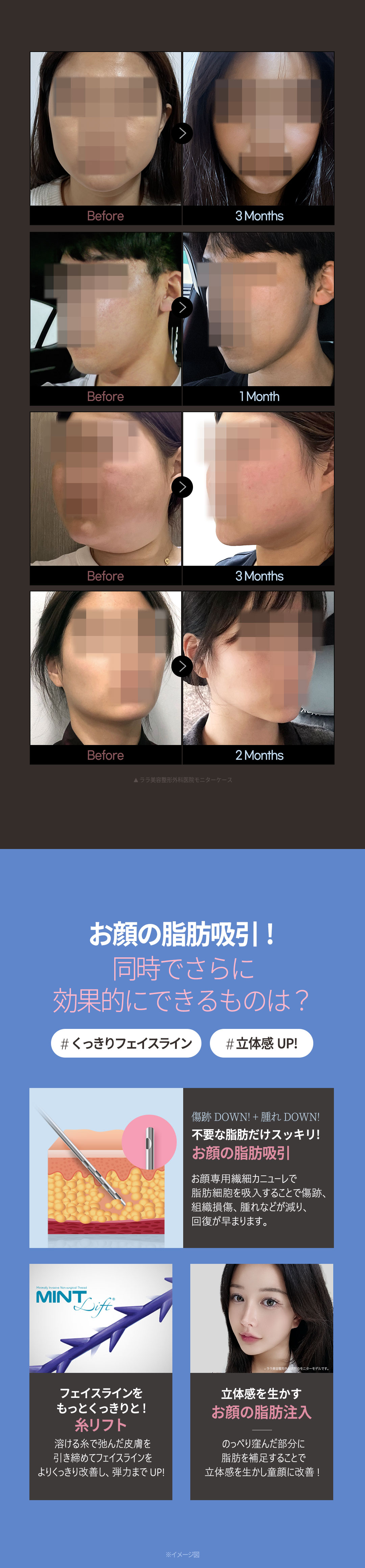 Hút mỡ mặt tạo V-line tự nhiên｜Thủ thuật tinh tế bằng phương pháp hút thủ công｜Lala Plastic Surgery ga Gangnam