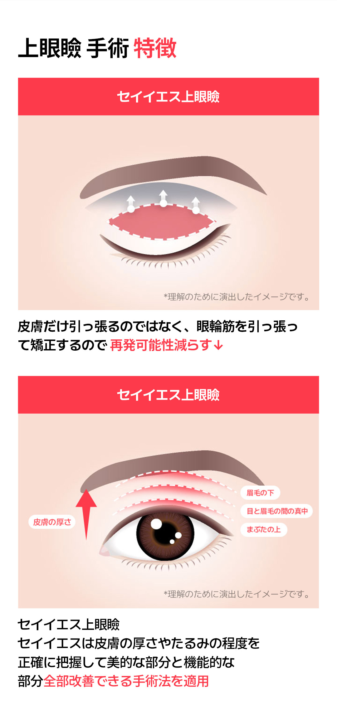 Hướng đến vùng mắt tự nhiên trẻ trung với phẫu thuật mi trên｜Cải thiện chảy xệ・Giảm nguy cơ tái phát｜Say Yes｜Seoul Gangnam
