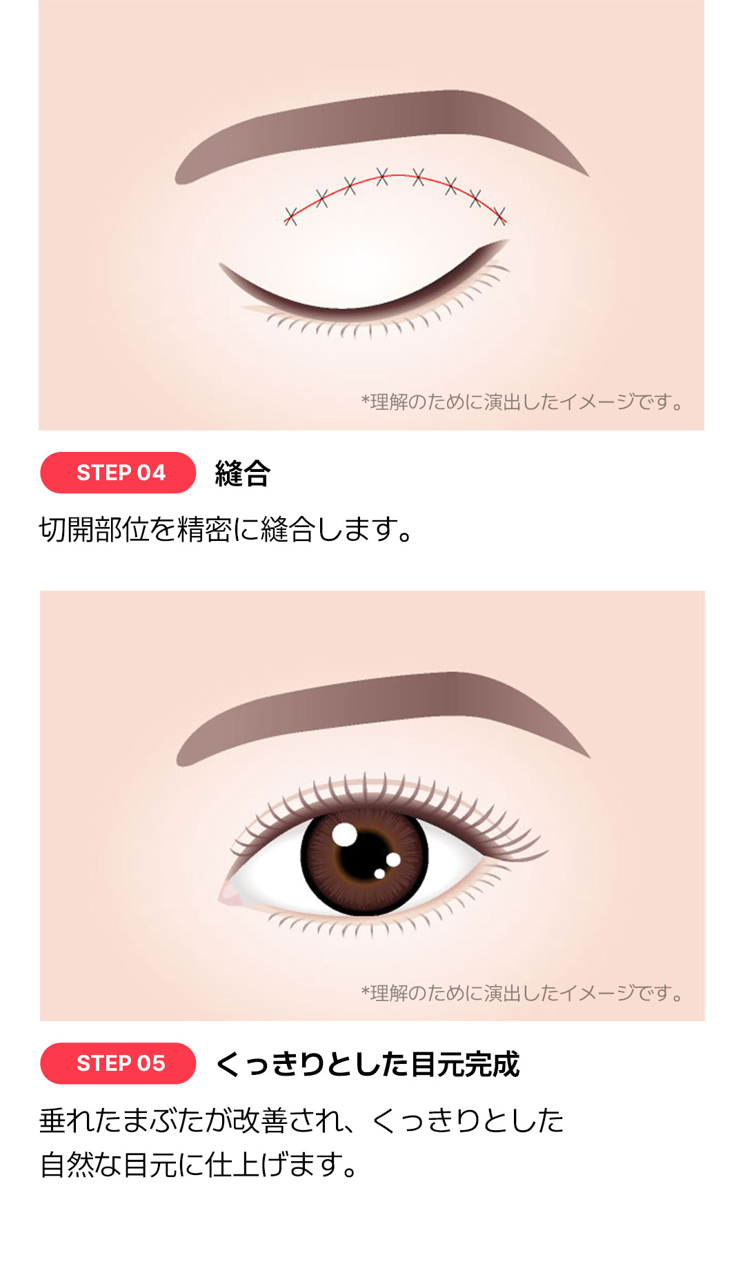 Hướng đến vùng mắt tự nhiên trẻ trung với phẫu thuật mi trên｜Cải thiện chảy xệ・Giảm nguy cơ tái phát｜Say Yes｜Seoul Gangnam