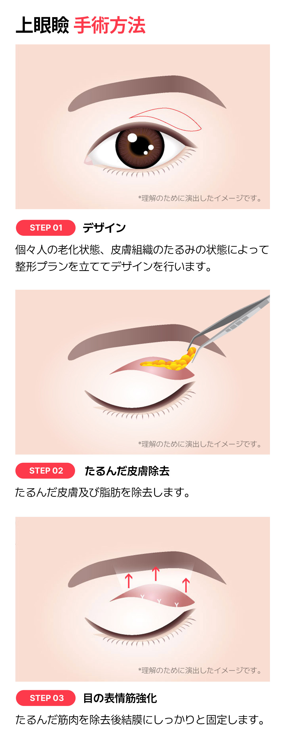 Hướng đến vùng mắt tự nhiên trẻ trung với phẫu thuật mi trên｜Cải thiện chảy xệ・Giảm nguy cơ tái phát｜Say Yes｜Seoul Gangnam