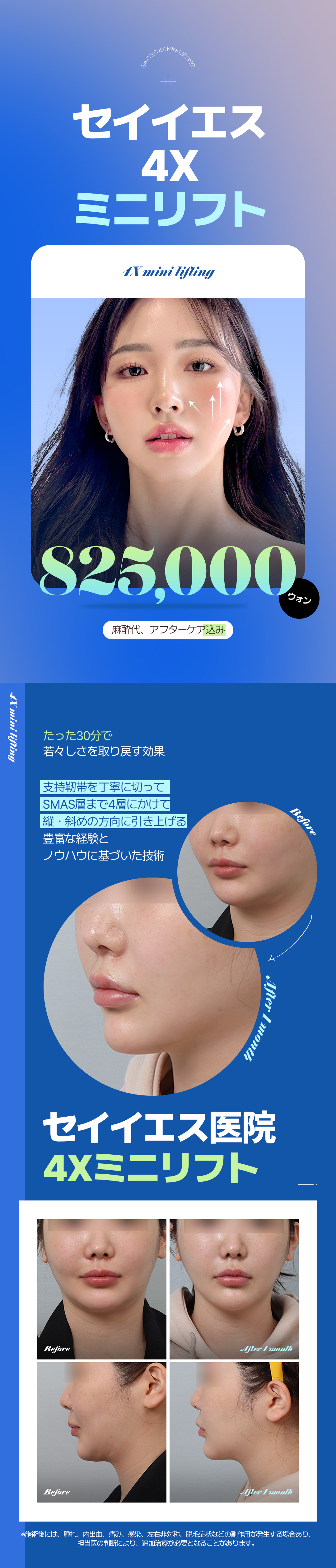 4X Mini Lift tại phòng khám Say Yes | Tiếp cận đồng thời 4 lớp nâng cơ tự nhiên tại bệnh viện thẩm mỹ quận Gangnam