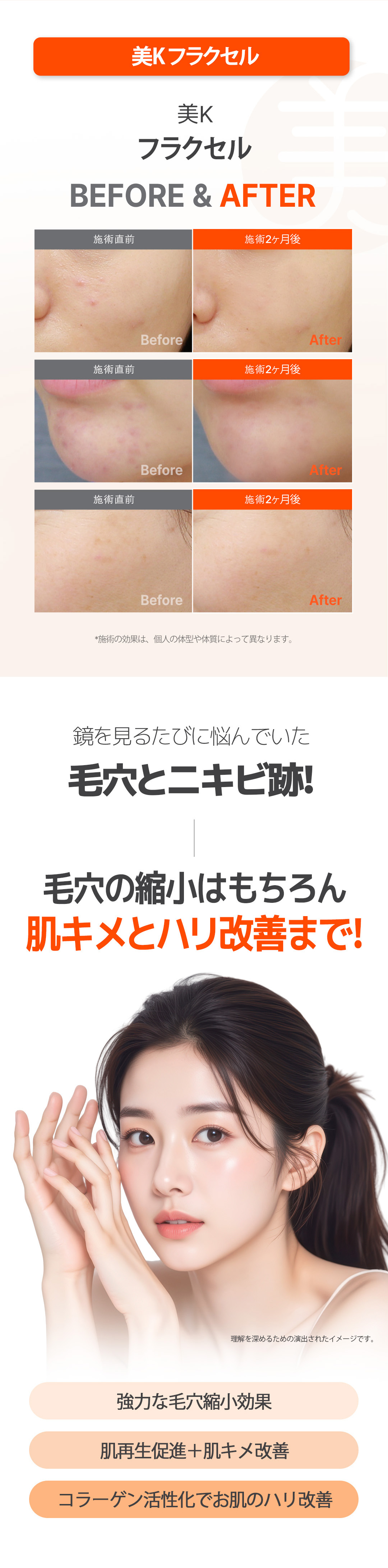 Chăm sóc lỗ chân lông・vết sẹo mụn với Laser Fraxel | Từ 5.716 yên~ | Seoul ga Gangnam Phòng khám Mikei | Hỗ trợ tiếng Nhật