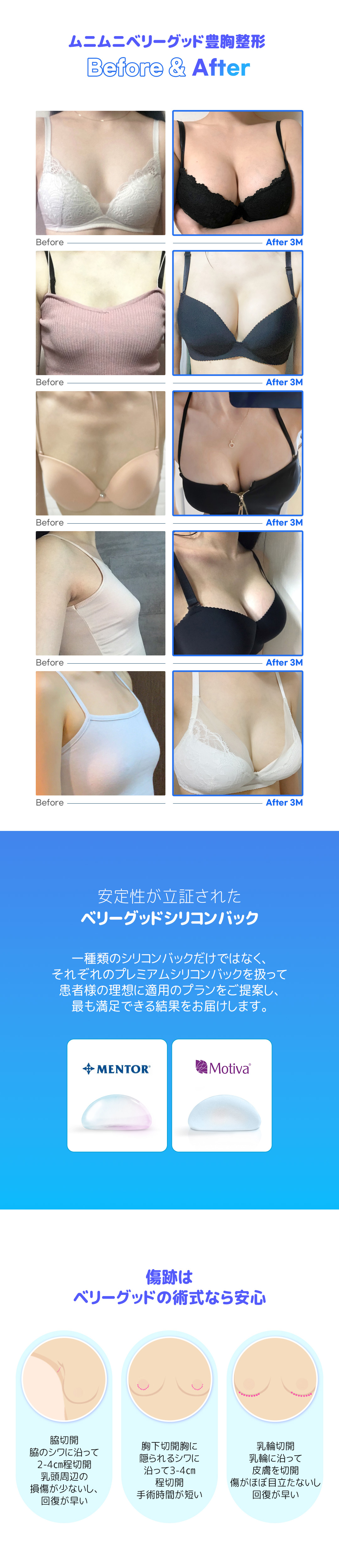 Phẫu thuật nâng ngực Hàn Quốc | Very Good Plastic Surgery kết nối trực tiếp ga Gangnam | Thẩm mỹ nâng ngực chú trọng an toàn với bác sĩ chuyên khoa thường trực