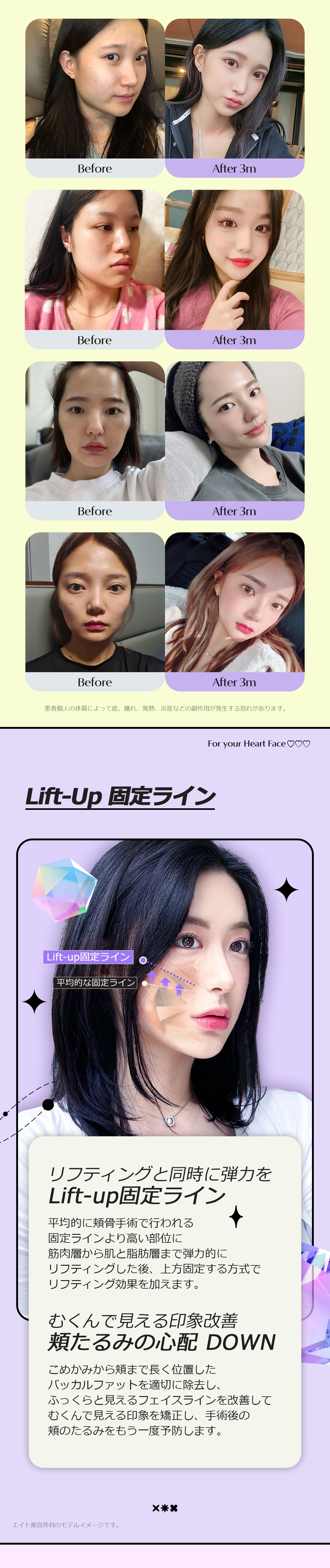 Bộ 3 điểm đường viền Eight Thẩm mỹ Hàn Quốc｜Tạo hình gò má, hàm, cằm hướng đến đường viền V-line｜Ga Apgujeong