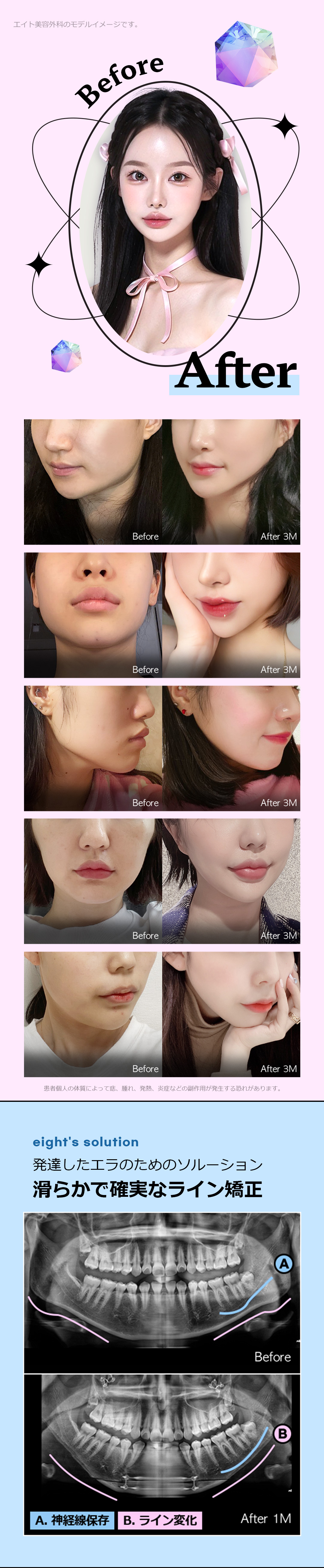 Bộ 3 điểm đường viền Eight Thẩm mỹ Hàn Quốc｜Tạo hình gò má, hàm, cằm hướng đến đường viền V-line｜Ga Apgujeong