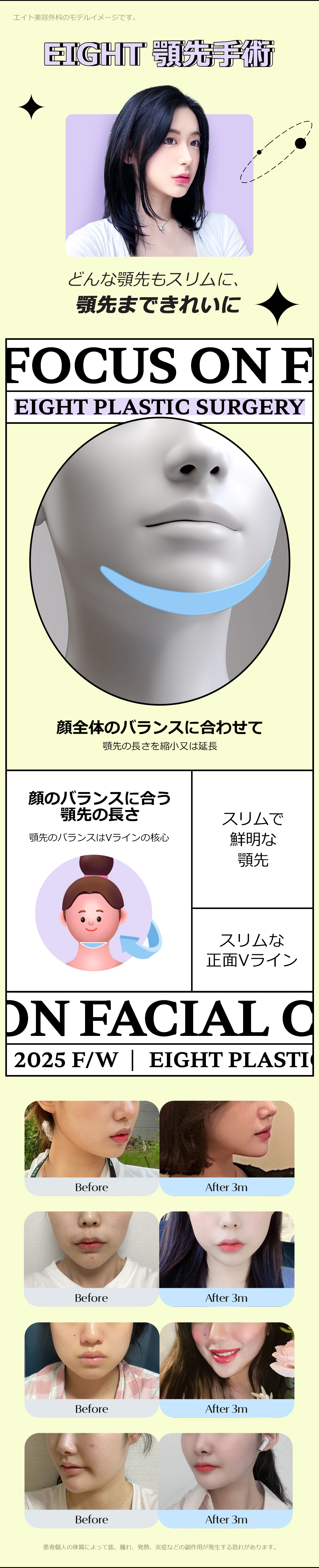 Bộ 3 điểm đường viền Eight Thẩm mỹ Hàn Quốc｜Tạo hình gò má, hàm, cằm hướng đến đường viền V-line｜Ga Apgujeong
