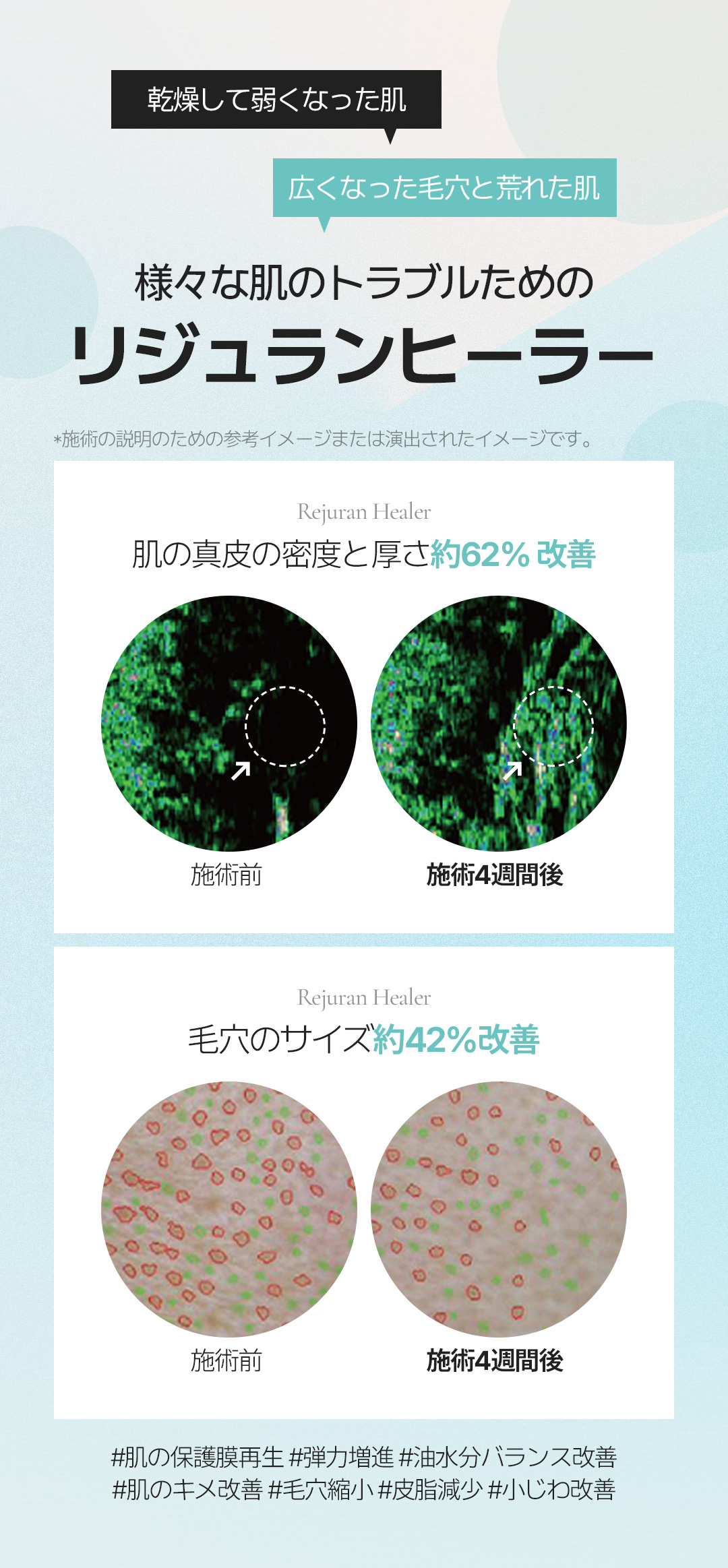 Liệu trình Rejuran Healer tại Phòng khám Say Yes | Hỗ trợ chăm sóc da bằng thành phần PN có nguồn gốc từ cá hồi