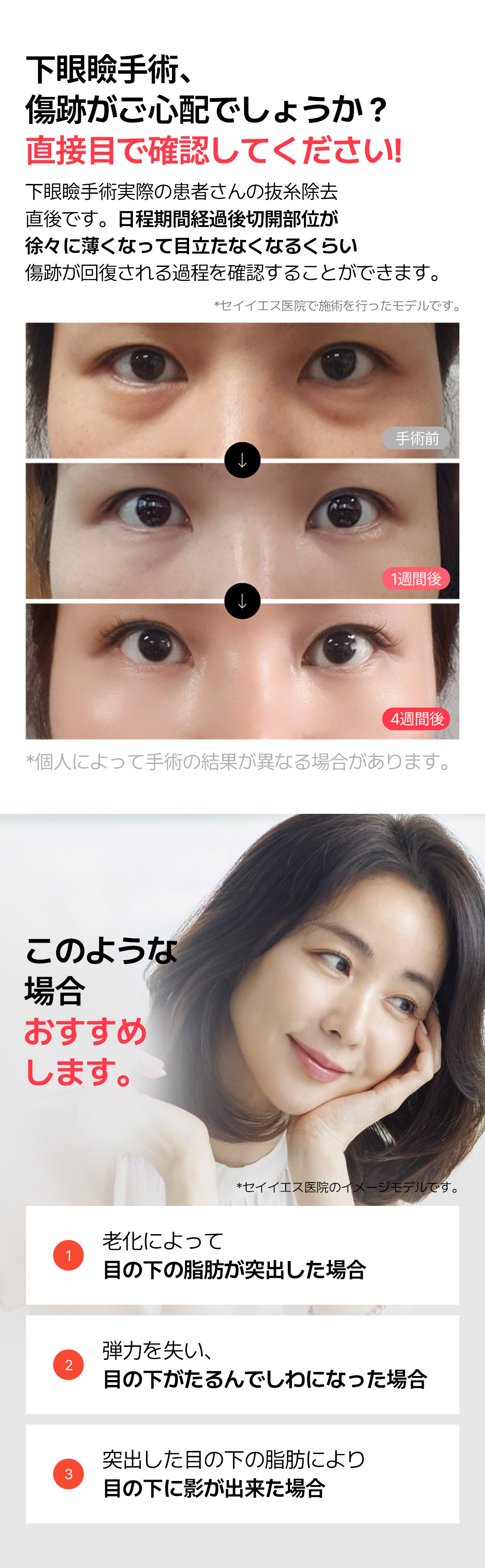 Hướng tới cải thiện chảy xệ・phồng mỡ vùng mắt với Phẫu thuật tạo hình mí dưới | Seoul Sinnonhyeon stn.・Phòng khám Sayyes