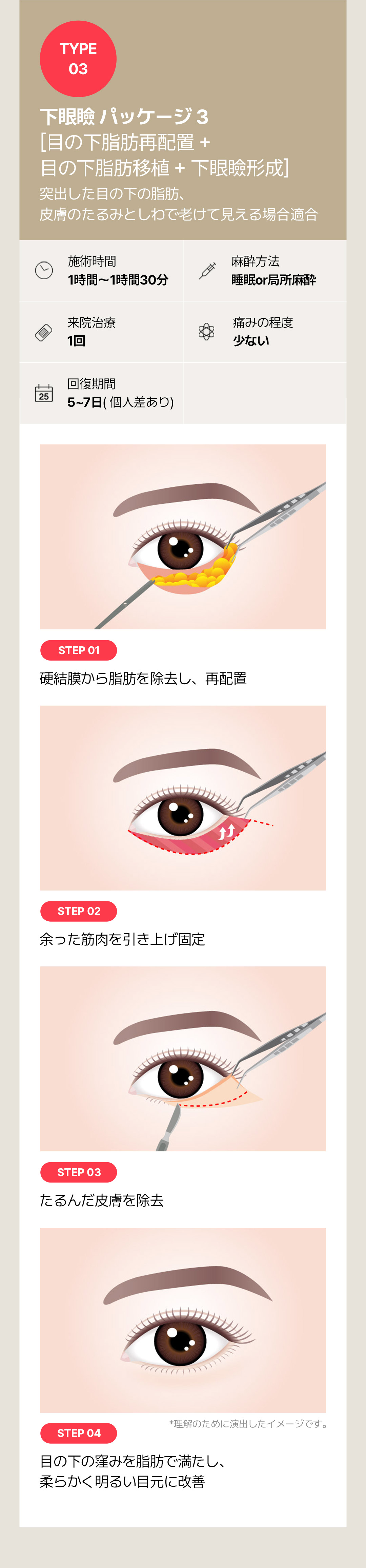 Hướng tới cải thiện chảy xệ・phồng mỡ vùng mắt với Phẫu thuật tạo hình mí dưới | Seoul Sinnonhyeon stn.・Phòng khám Sayyes