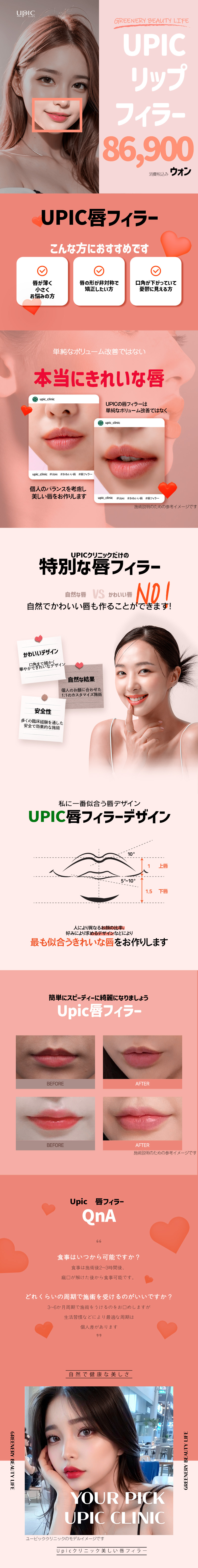 Liệu pháp Filler môi tại Phòng khám Upik Hàn Quốc Hongdae | Hướng đến độ đầy môi tự nhiên | 9.408 yên