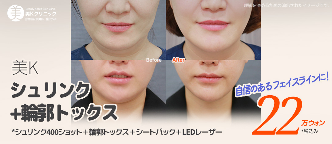 Shrink 400 shot + Contour Tox chăm sóc V-line mặt nhỏ | Phòng khám MiK Seoul ga Gangnam
