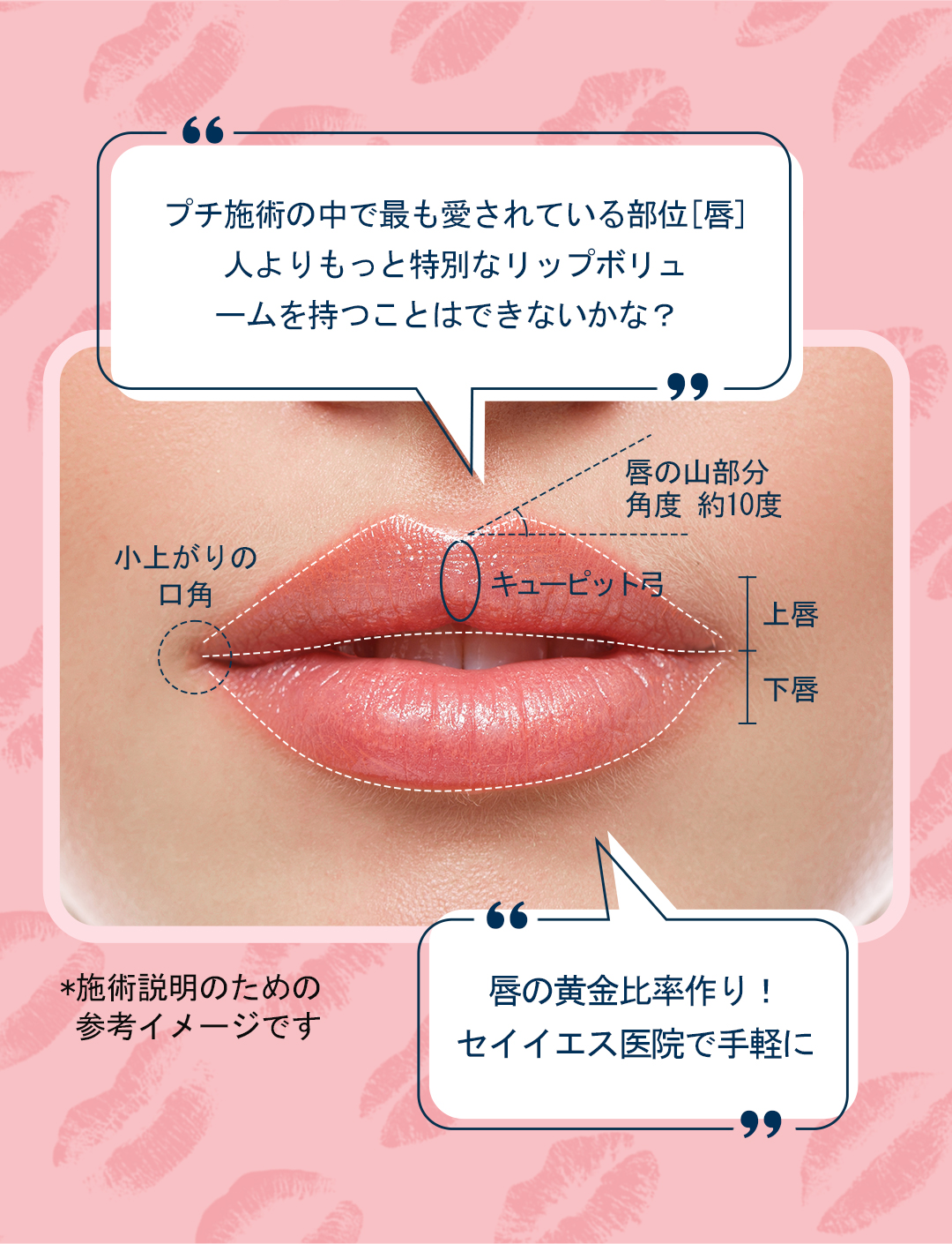 Filler môi Restylane Kysse | Hướng đến tăng volume tự nhiên với filler chuyên dụng cho môi được FDA phê duyệt | Say Yes Phòng khám Seoul