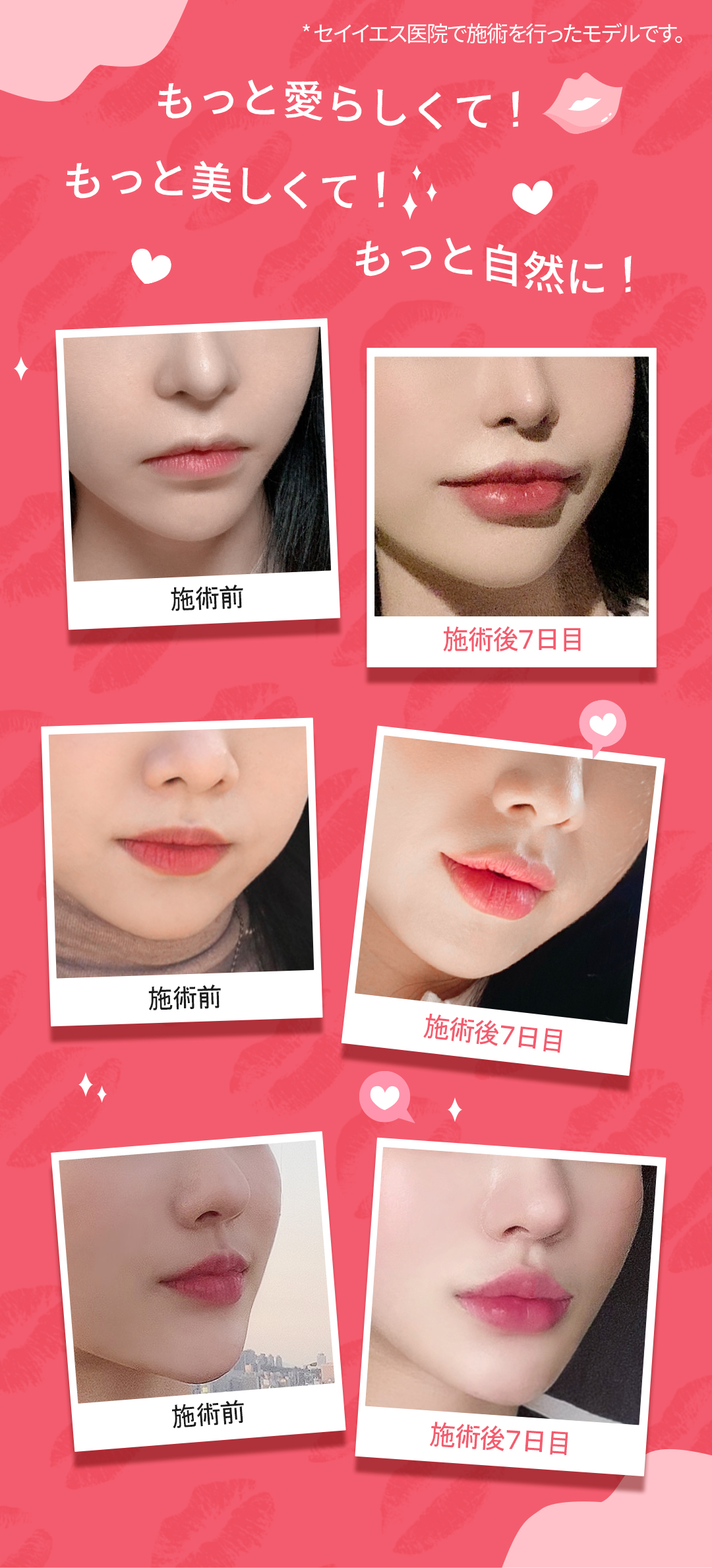 Filler môi Restylane Kysse | Hướng đến tăng volume tự nhiên với filler chuyên dụng cho môi được FDA phê duyệt | Say Yes Phòng khám Seoul