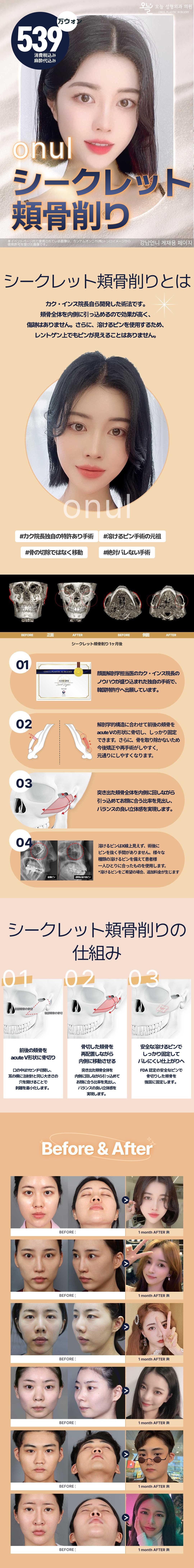 Gọt gò má bí mật｜Phẫu thuật tạo hình đường viền đạt bằng sáng chế｜Sẹo khó thấy sử dụng pin tan｜Onul Thẩm mỹ Phẫu thuật Tạo hình