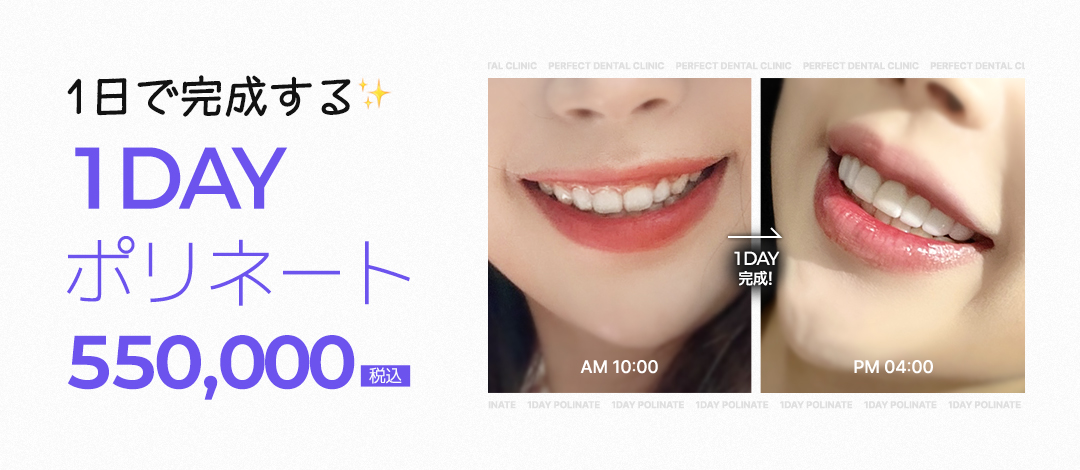 1DAY Polynate | Laminate Veneer không mài ít đau | Gangnam Perfect Dental [Hoàn thành trong ngày]
