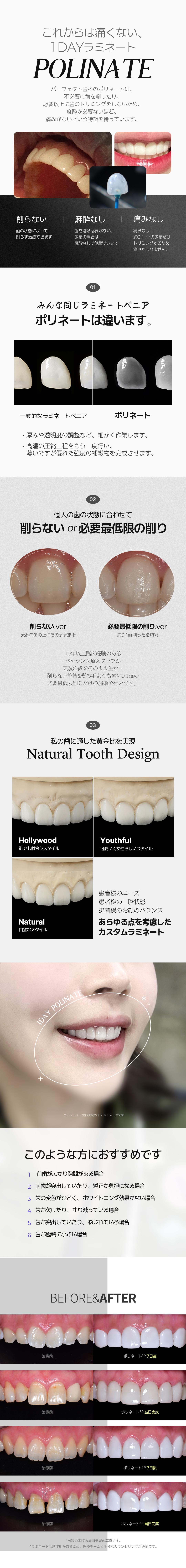 1DAY Polynate | Laminate Veneer không mài ít đau | Gangnam Perfect Dental [Hoàn thành trong ngày]