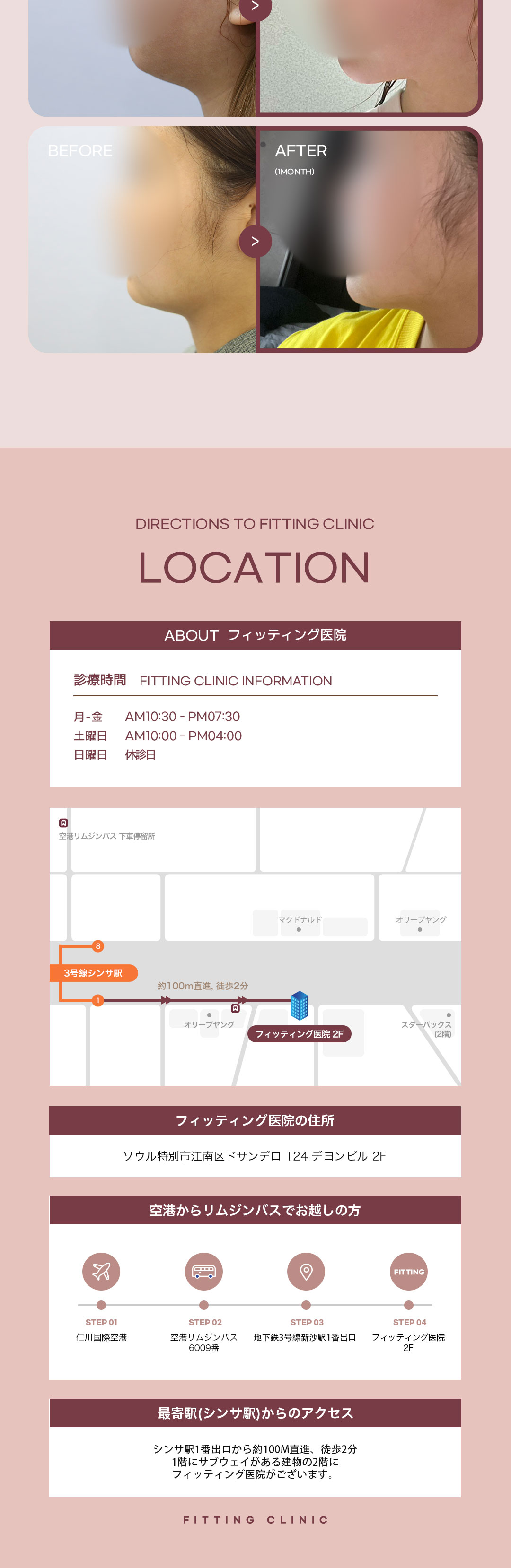 Hút mỡ mặt tạo mặt nhỏ gọn gàng | Cải thiện mỡ buccal và nọng cằm | Fitting Sinsa Seoul