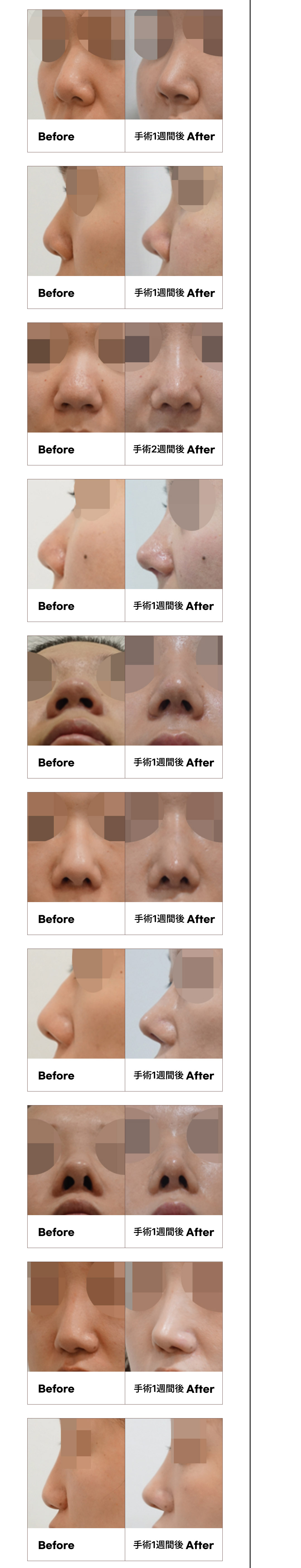 Phẫu thuật mũi củ tỏi không mở Hàn Quốc | Chỉnh đầu mũi sẹo khó thấy | The Tight Thẩm mỹ | Quận Gangnam Seoul