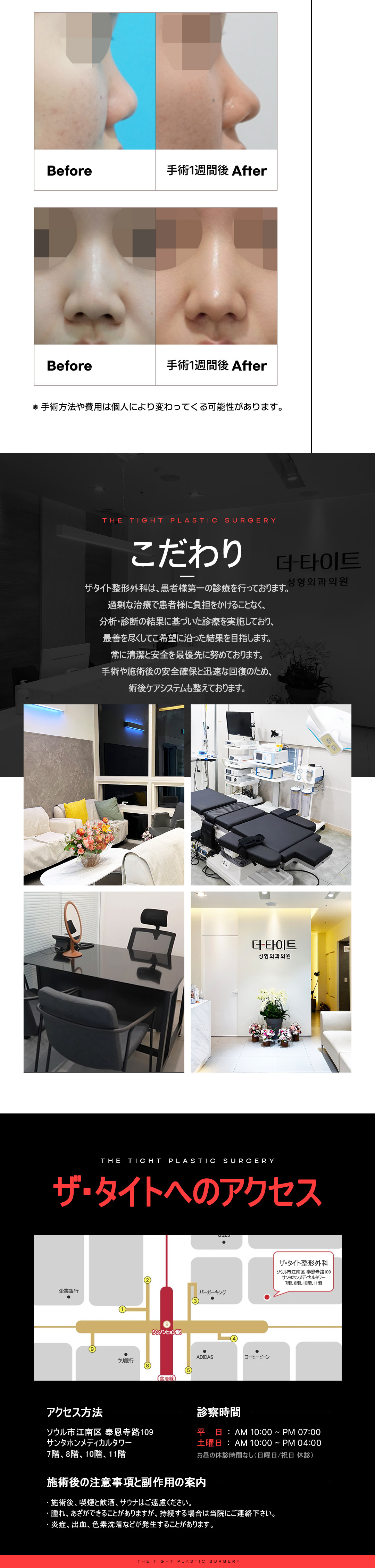 Phẫu thuật mũi củ tỏi không mở Hàn Quốc | Chỉnh đầu mũi sẹo khó thấy | The Tight Thẩm mỹ | Quận Gangnam Seoul