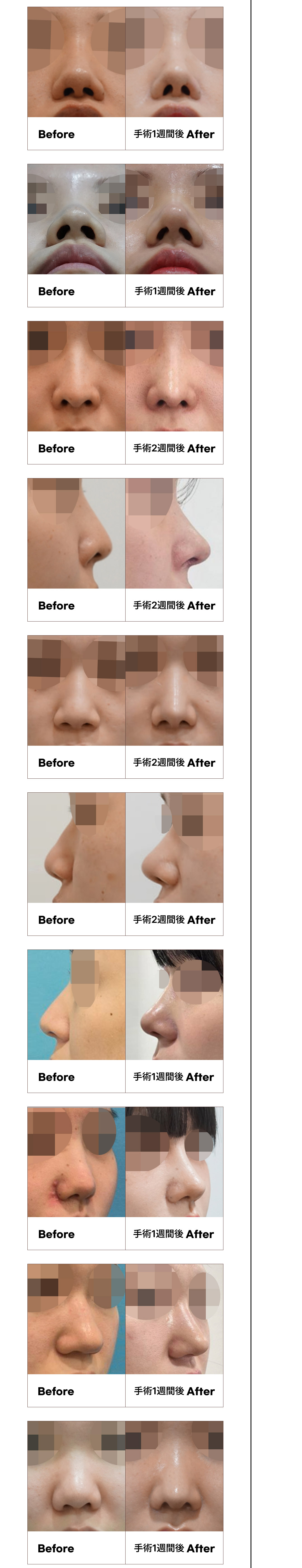 Phẫu thuật mũi củ tỏi không mở Hàn Quốc | Chỉnh đầu mũi sẹo khó thấy | The Tight Thẩm mỹ | Quận Gangnam Seoul