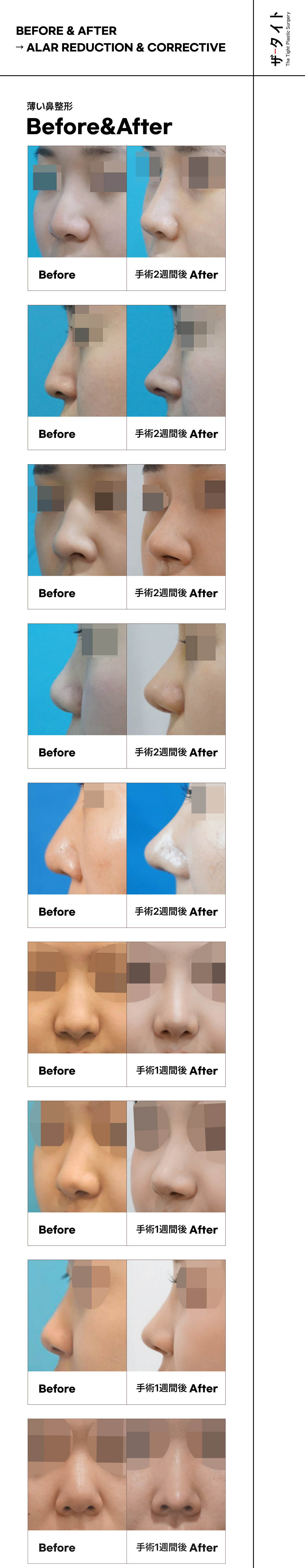 Phẫu thuật mũi củ tỏi không mở Hàn Quốc | Chỉnh đầu mũi sẹo khó thấy | The Tight Thẩm mỹ | Quận Gangnam Seoul