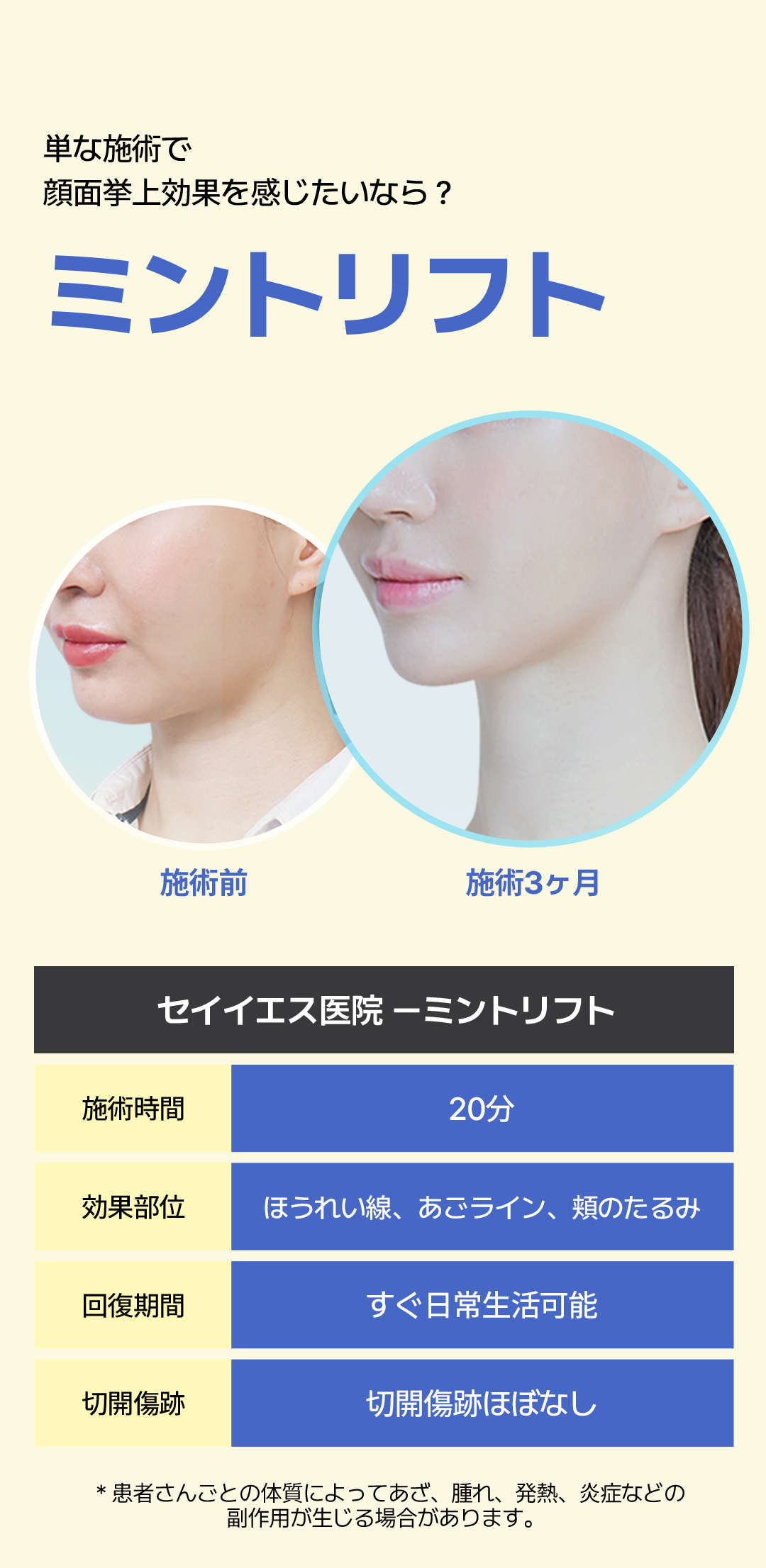 Chỉ nâng Mint Lift hướng đến nâng cơ tự nhiên | Điều trị 20 phút, sinh hoạt hàng ngày ngay | Phòng khám Say Yes