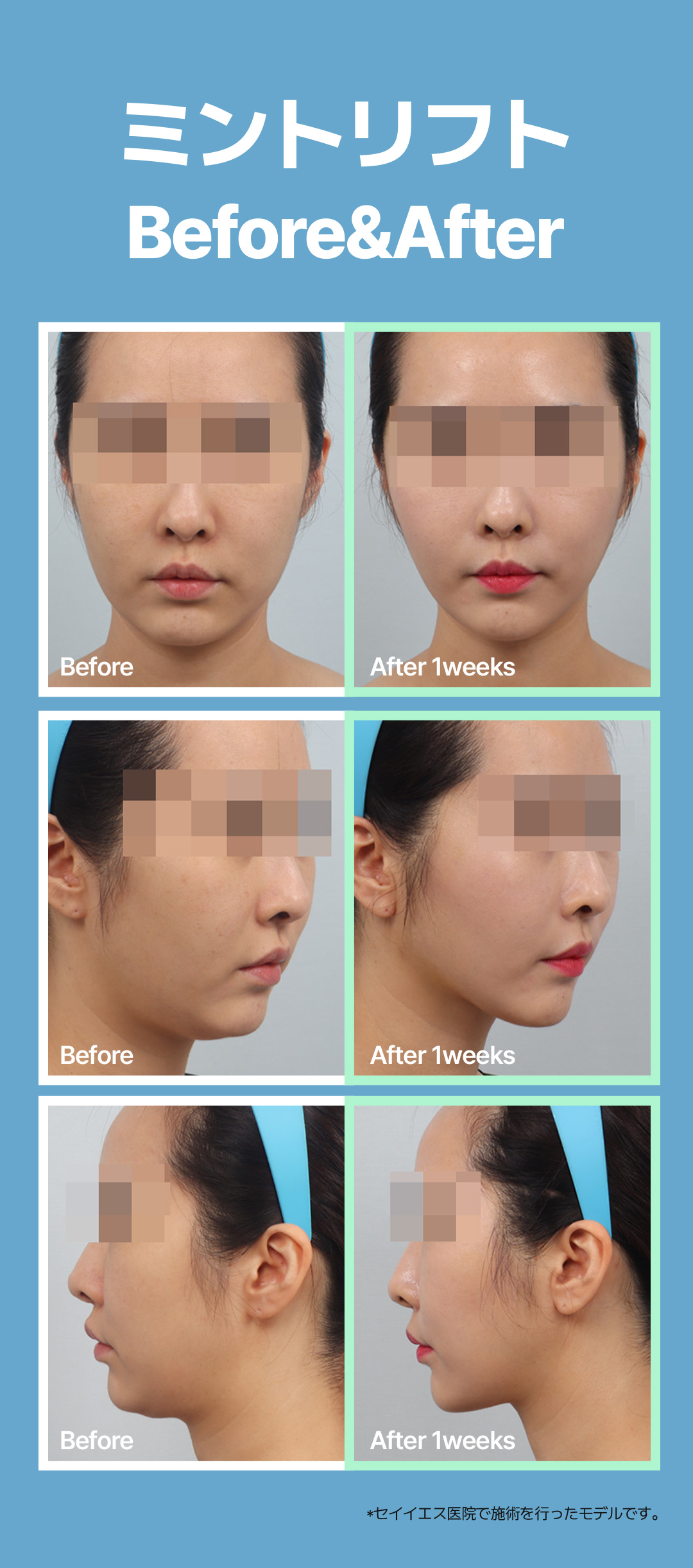 Chỉ nâng Mint Lift hướng đến nâng cơ tự nhiên | Điều trị 20 phút, sinh hoạt hàng ngày ngay | Phòng khám Say Yes