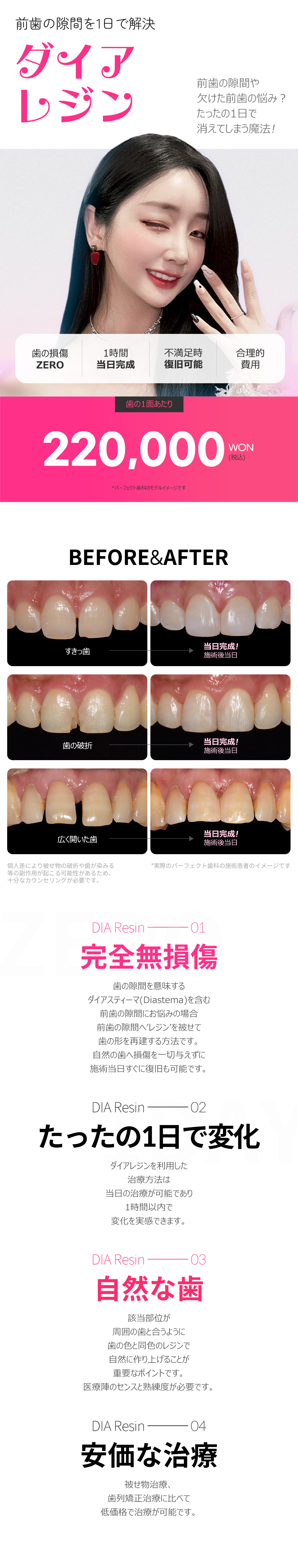 Hướng tới cải thiện khoảng cách răng cửa bằng Dia Resin | Hoàn thành 1 ngày・Không mài răng | Perfect Dental