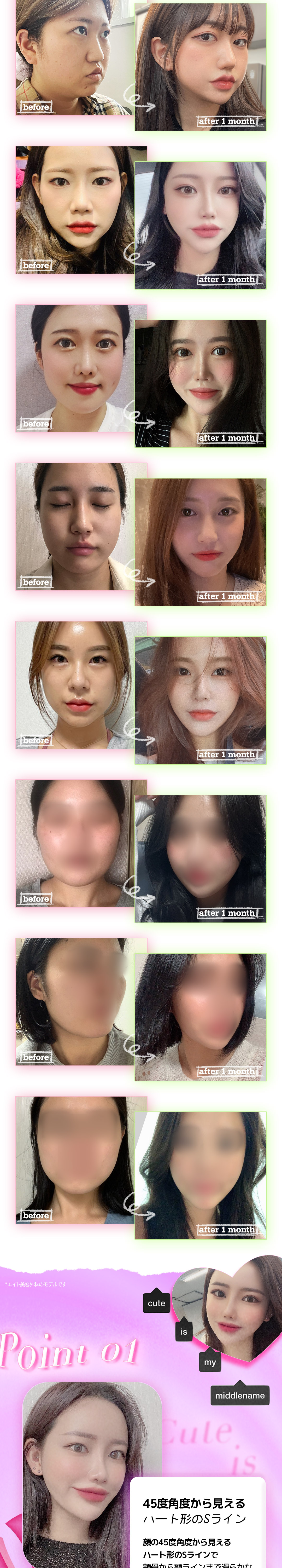 Hút mỡ cằm đôi + buộc cơ để đường viền mặt gọn gàng｜Thủ thuật V-line không gọt xương｜Eight Plastic Surgery