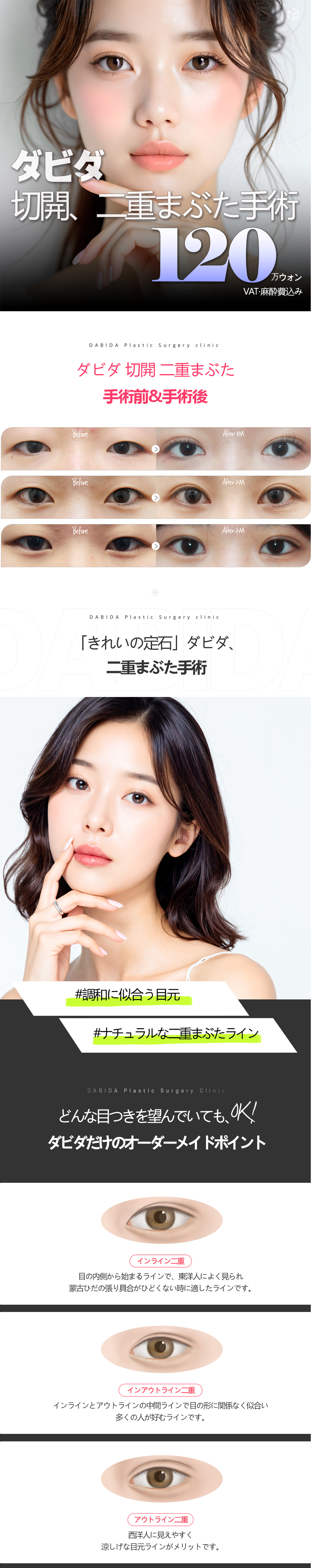Phẫu thuật cắt mí đôi | Tạo đường nét tự nhiên bởi bác sĩ chuyên khoa Hàn Quốc | Davida Thẩm mỹ【Apgujeong】