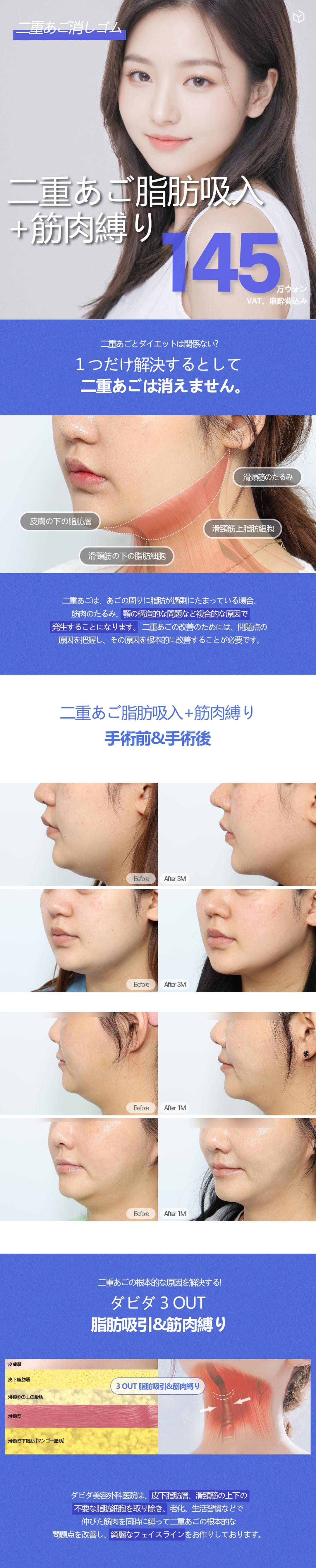 Hút mỡ nọng cằm + buộc cơ | Loại bỏ mỡ 3 lớp cải thiện từ gốc | Davida