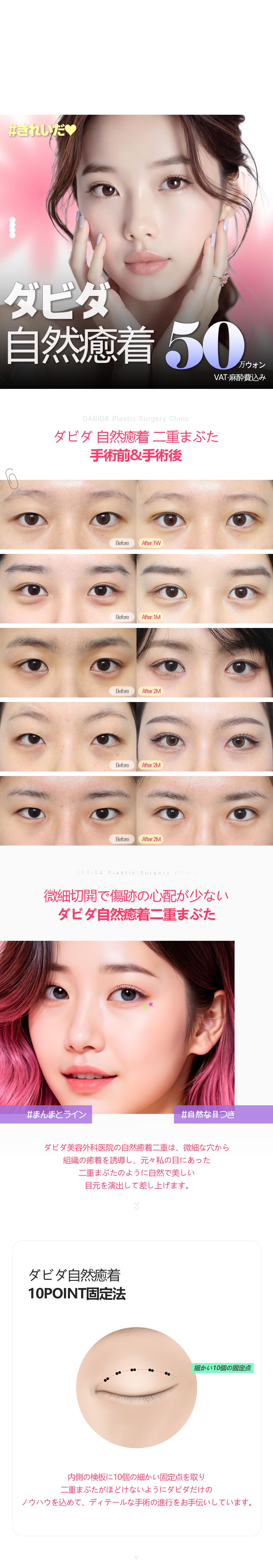 Phẫu thuật tạo mí đôi dính tự nhiên | Hướng tới kết quả tự nhiên với phương pháp cố định 10 ĐIỂM | Phòng khám Davida Thẩm mỹ