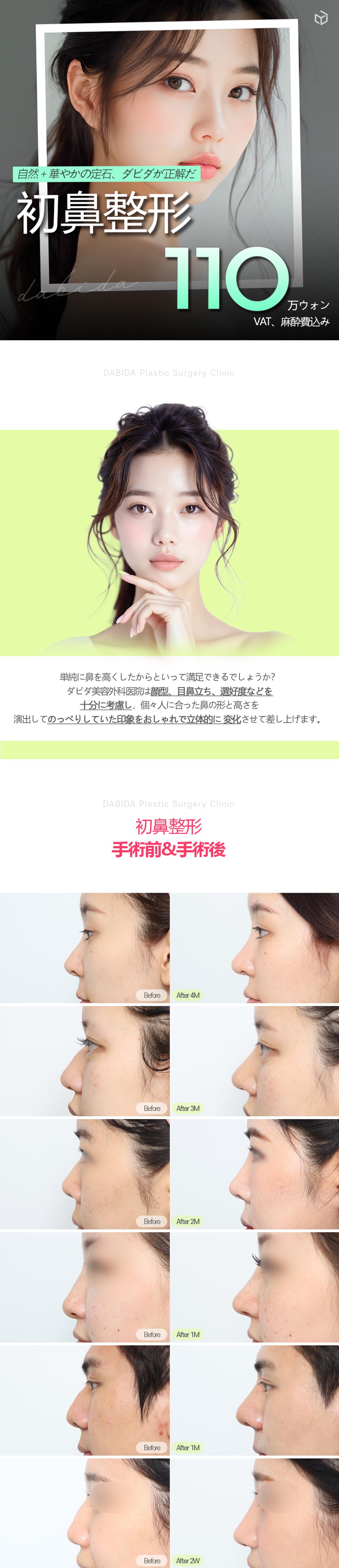 Phẫu thuật mũi lần đầu (Tạo hình đầu mũi・Nâng mũi) Hướng tới vẻ đẹp tự nhiên với tỷ lệ vàng | Davida Thẩm mỹ Apgujeong