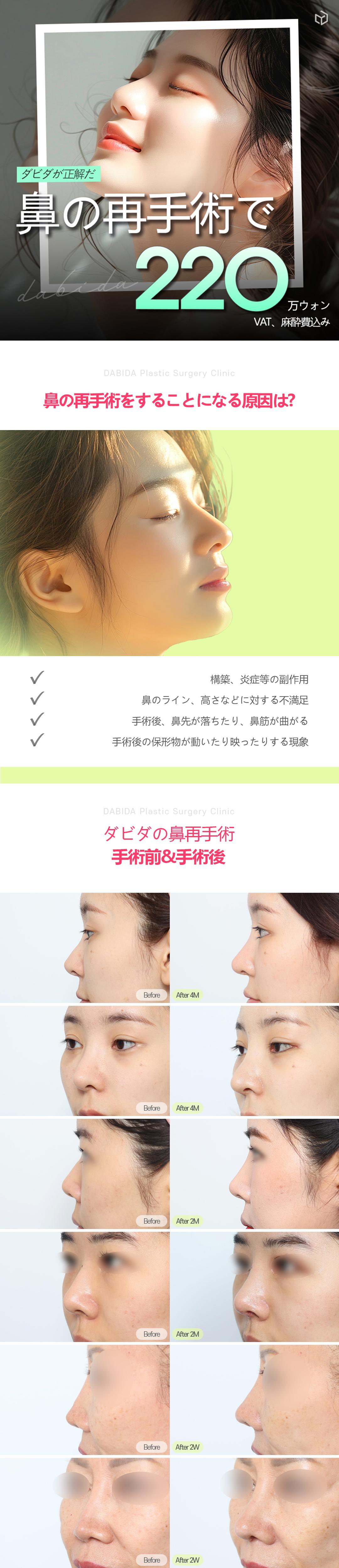 Phẫu thuật lại mũi | Hướng tới đường nét mũi lý tưởng với phân tích chính xác 3D-CT | Seoul Apgujeong Davida Phẫu thuật Thẩm mỹ