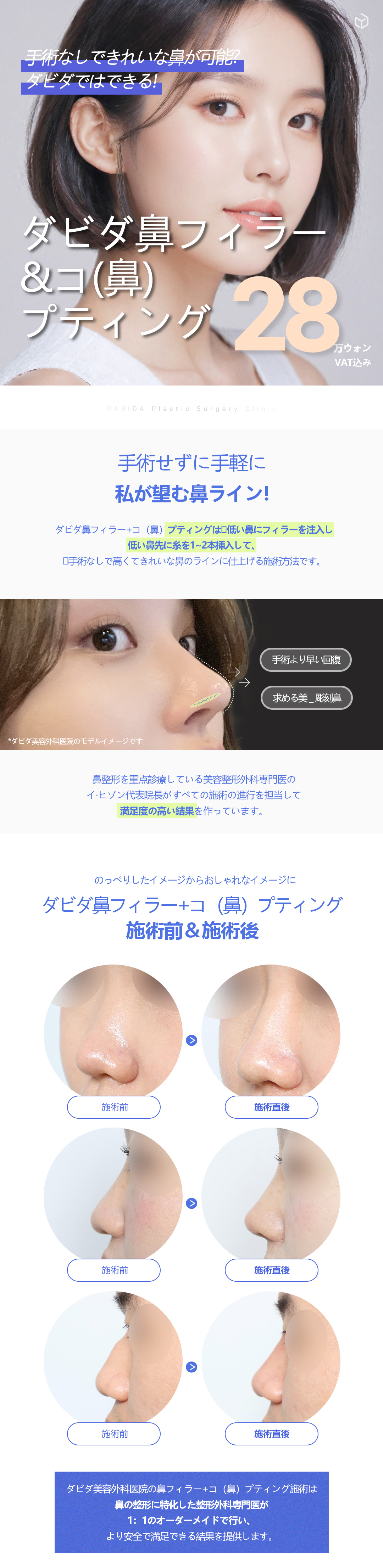 Filler mũi + Copting Hàn Quốc | Hướng đến đường mũi lý tưởng không phẫu thuật | Davida Clinic