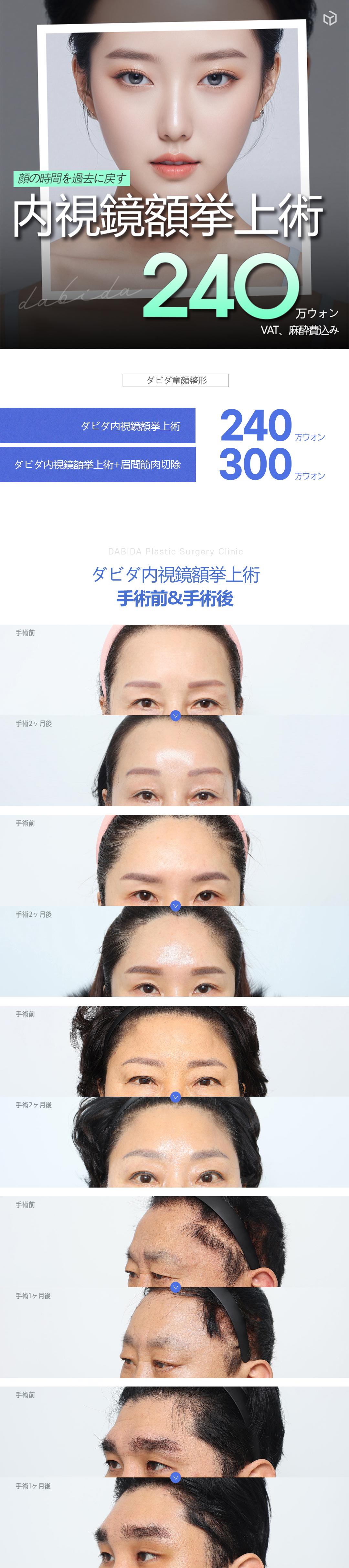 Phòng khám Thẩm mỹ Ngoại khoa Davida Hàn Quốc｜Nhắm đến trẻ hóa vùng trên mặt bằng phẫu thuật nâng trán nội soi｜Trong khoảng cách đi bộ từ ga Apgujeong