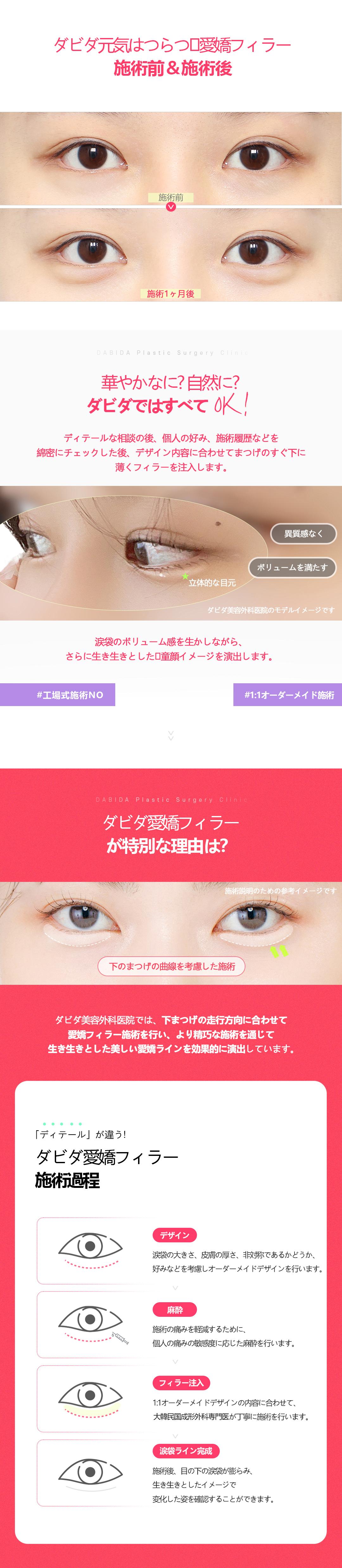 Filler hyaluronic acid túi mỡ mắt | Đường nét duyên dáng tự nhiên với điều trị tùy chỉnh 1:1 | Davida Thẩm mỹ viện Apgujeong