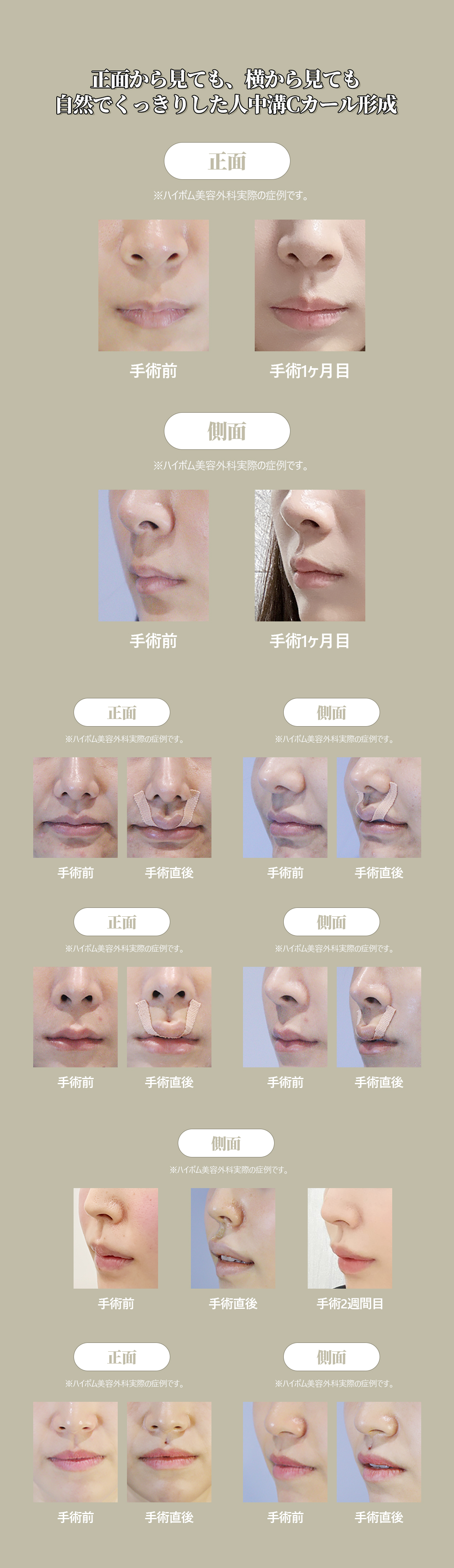 Đường môi tự nhiên với phẫu thuật tạo rãnh nhân trung C-curl | Liệu trình rạch trong miệng khó thấy sẹo | Haibeom Thẩm mỹ viện