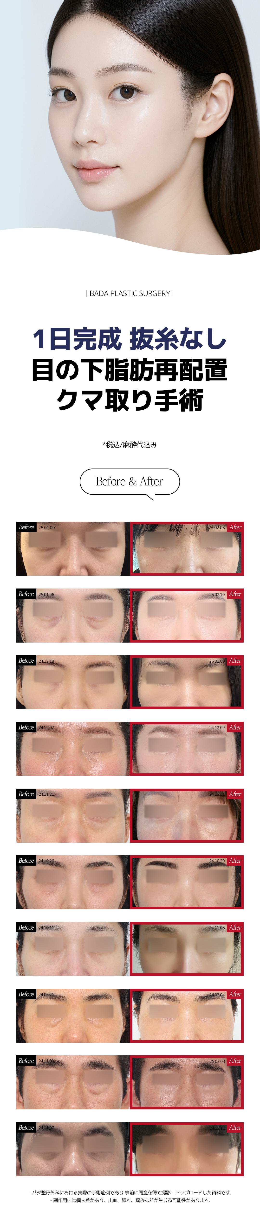 Điều trị tái phân bổ mỡ dưới mắt cải thiện quầng thâm | Hoàn thành 1 ngày, không cần cắt chỉ | Bada Seomyeon Busan