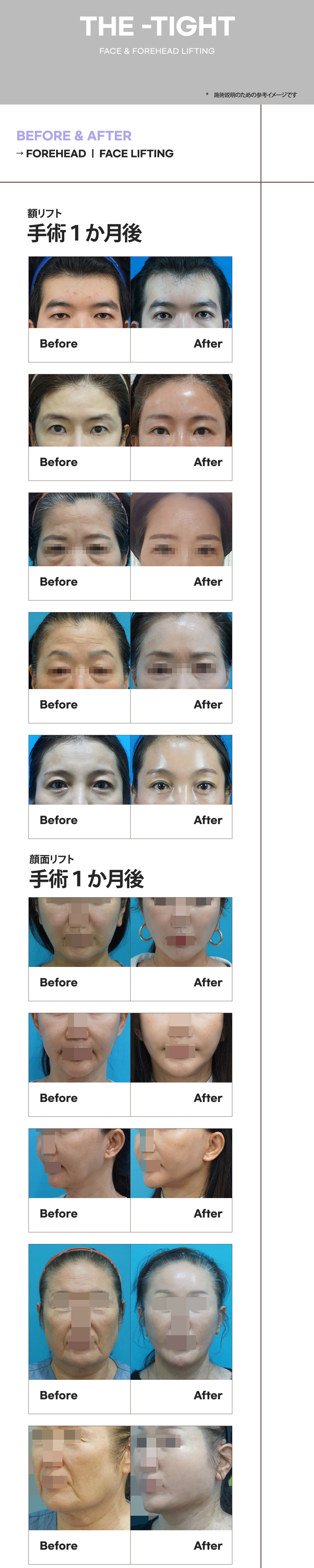 Hàn Quốc Gangnam The Tight Plastic Surgery Facelift・Nâng trán | Điều trị Top Lifting chọn theo từng vùng