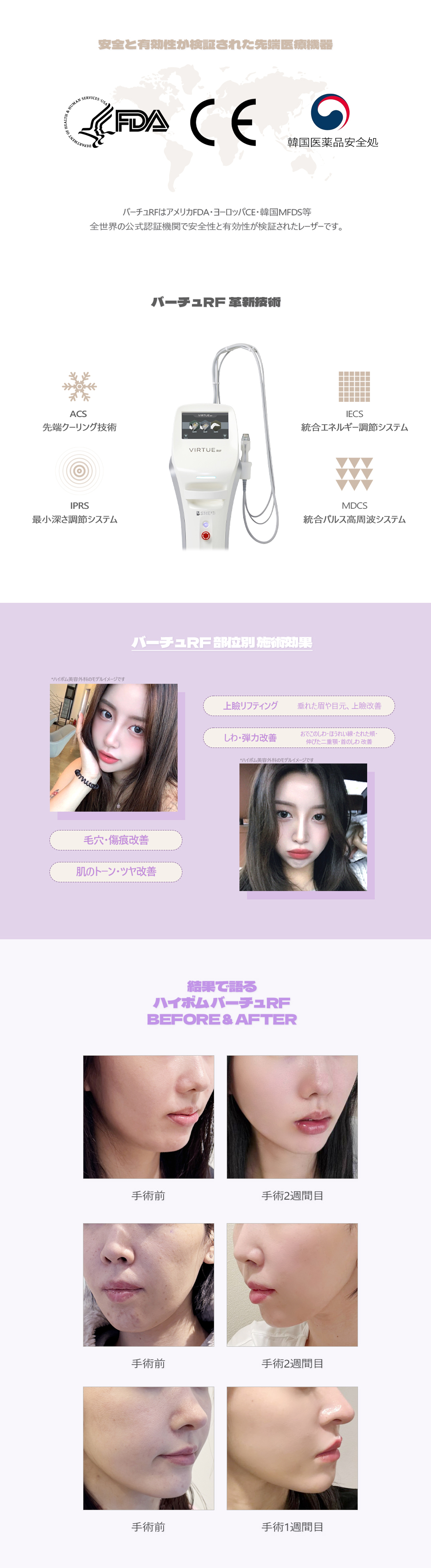 Virtue RF Lifting cao tần｜Liệu trình có thể kỳ vọng cải thiện chảy xệ, lỗ chân lông, nếp nhăn｜Phòng khám Thẩm mỹ Ngoại khoa Highbeom