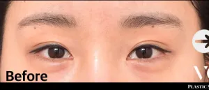 Before
