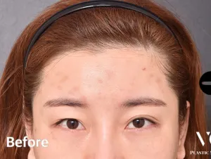 Before