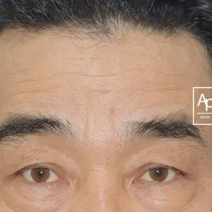 Before