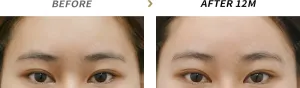 Before