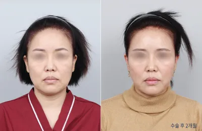 Before & After