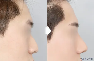 Before & After