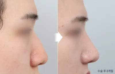 Before & After