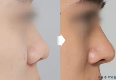 Before & After
